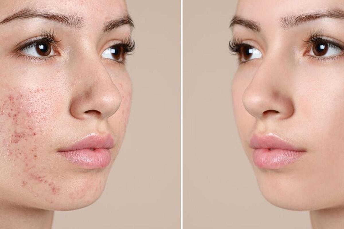 dua gambar seorang wanita dengan muka dengan ruam di hidungnya